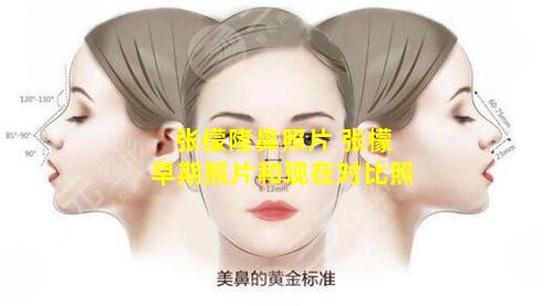 张檬隆鼻照片 张檬早期照片和现在对比照